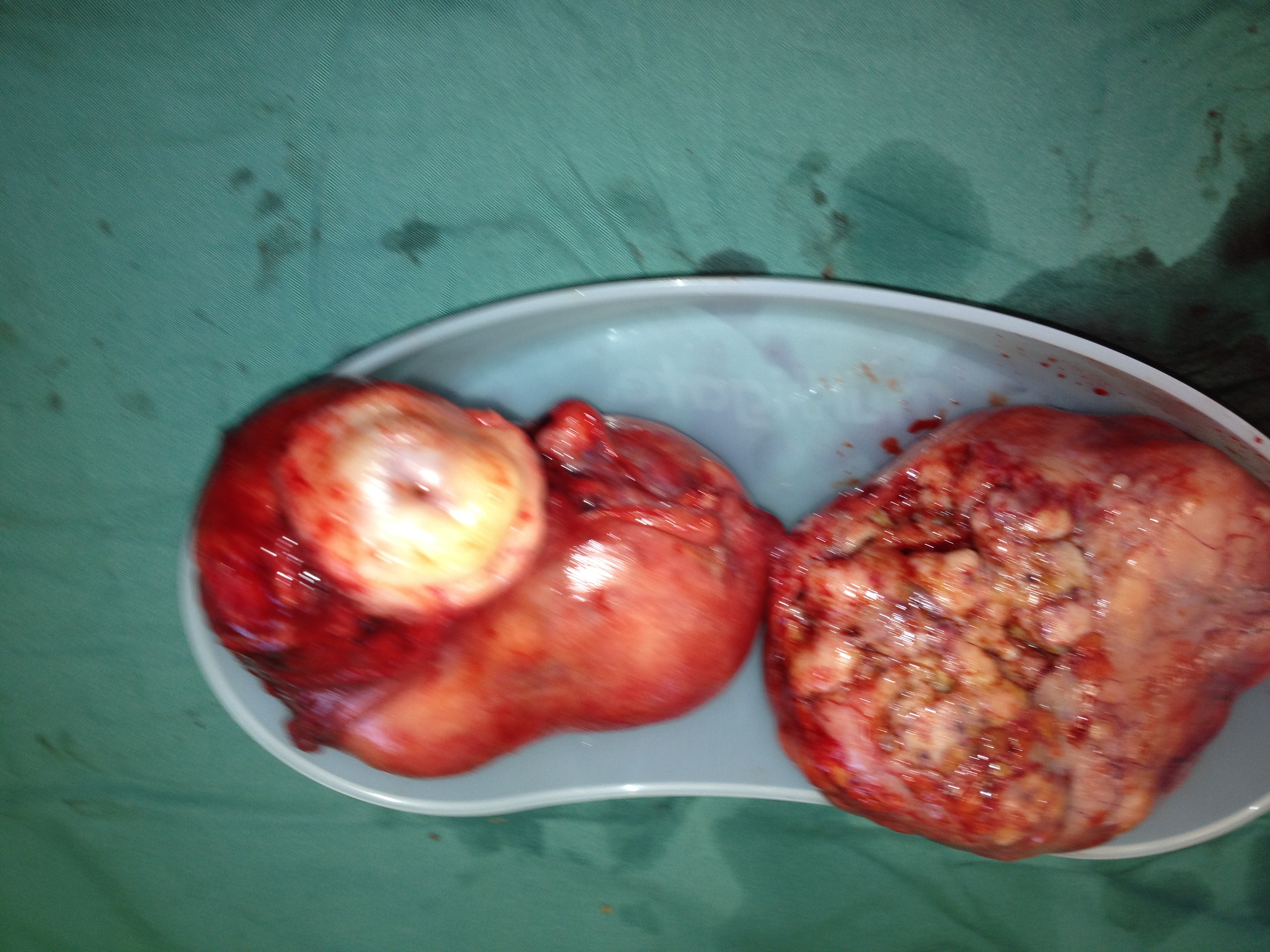 Uterine Artery Embolization Necrosis Hysterectomy Serag Youssif